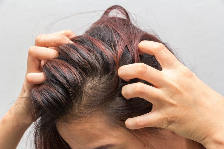 Itchy scalp greasy hair