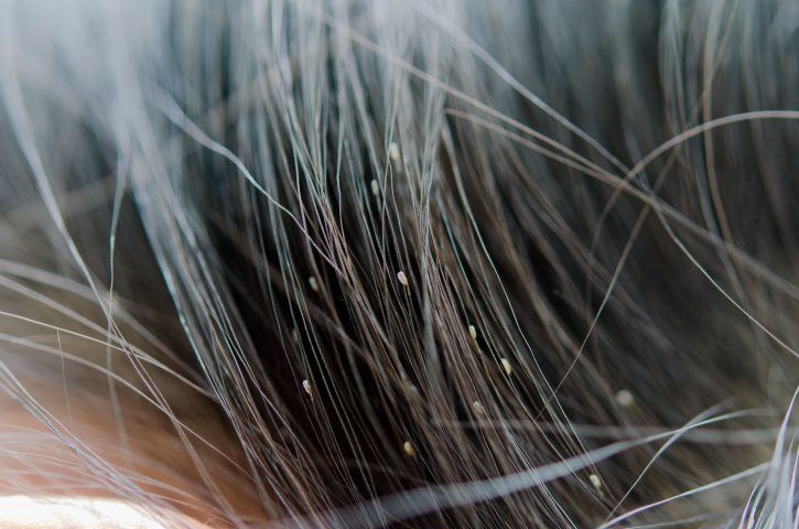 how to remove lice from hair