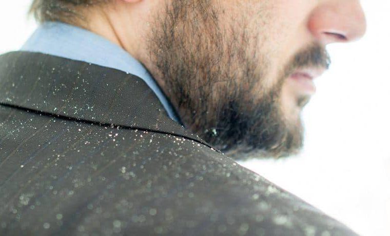 how to prevent dandruff